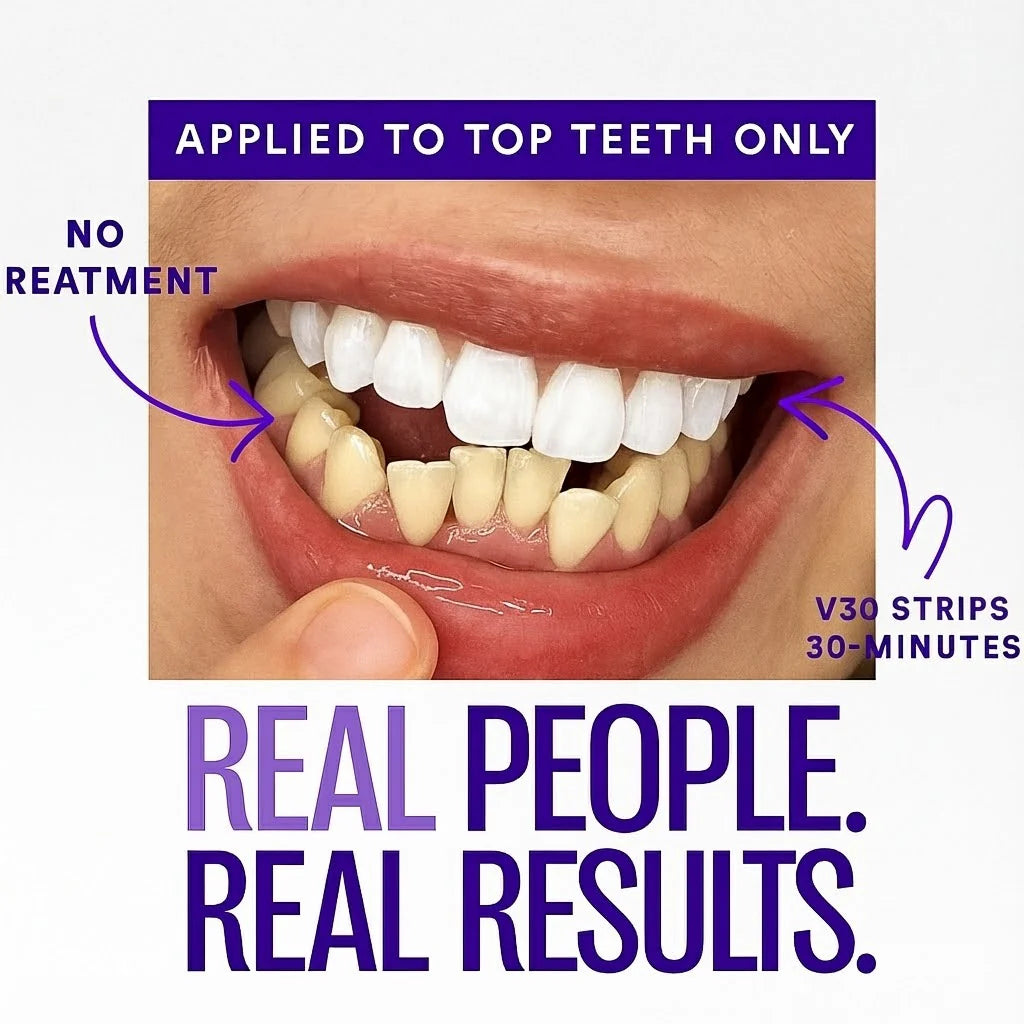 SOFTORASKIN™ Purple Whitening Strips