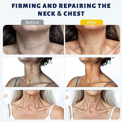 SOFTORASKIN™ 5-Roller Neck Firming Cream – Collagen & Hyaluronic Acid for Smoother, Tighter-Looking Neck Skin