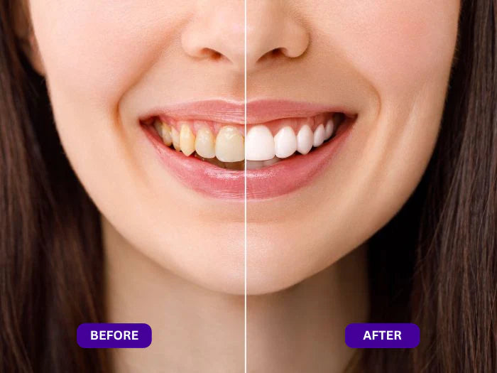 SOFTORASKIN™ Purple Whitening Strips