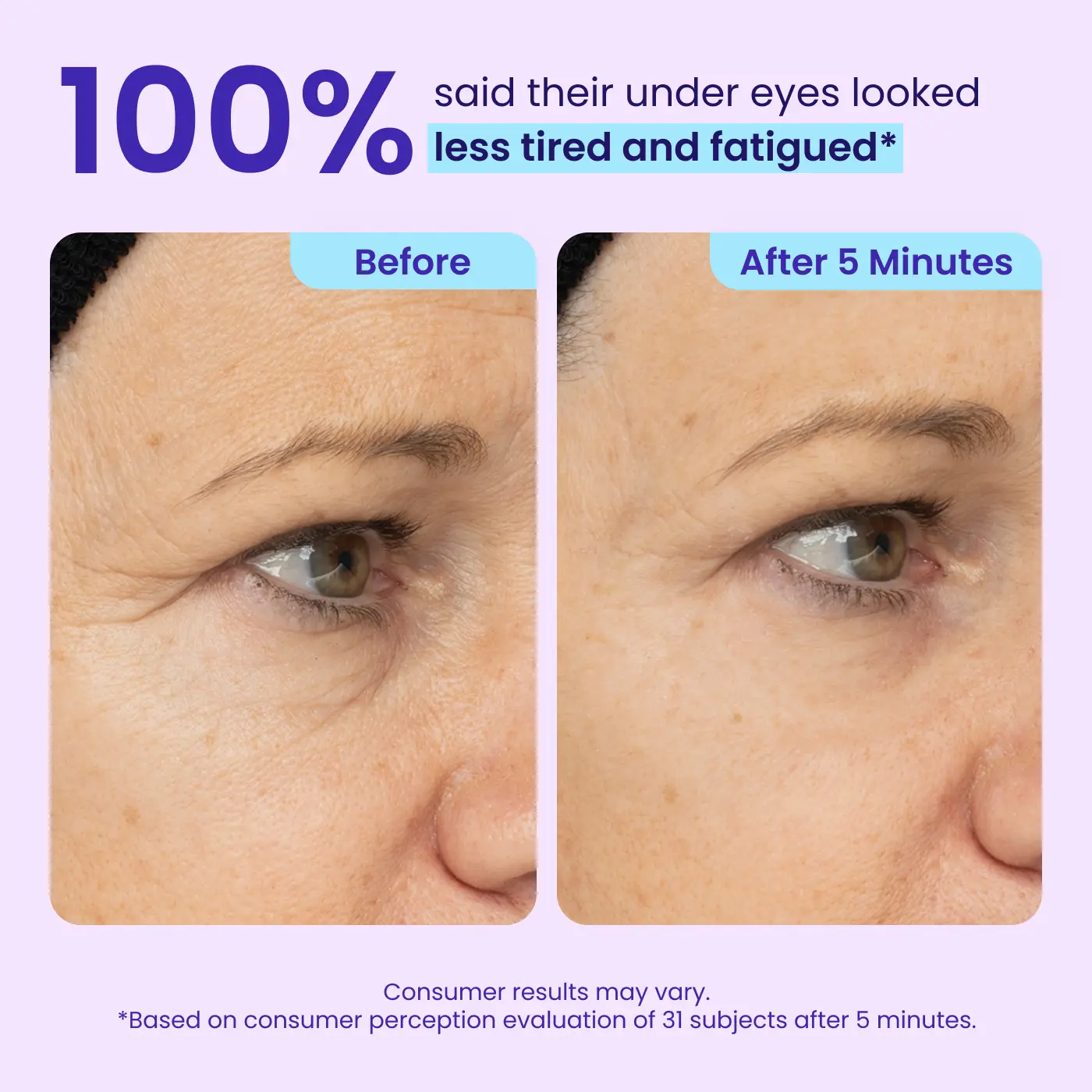 SOFTORASKIN™ Eye Bag Instant Eraser – Tightens, Smooths & Depuffs