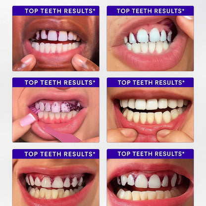 SOFTORASKIN™ Purple Whitening Strips